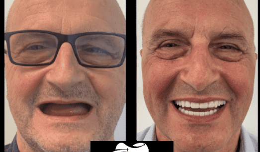 השתלות שיניים בעפולה