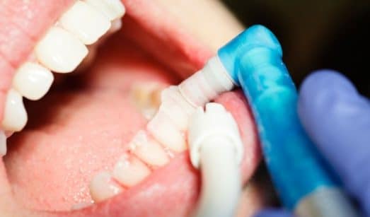 האם ניתן לבצע ביום אחד עקירה, השתלת עצם והחדרת שתלים תחת הרדמה כללית