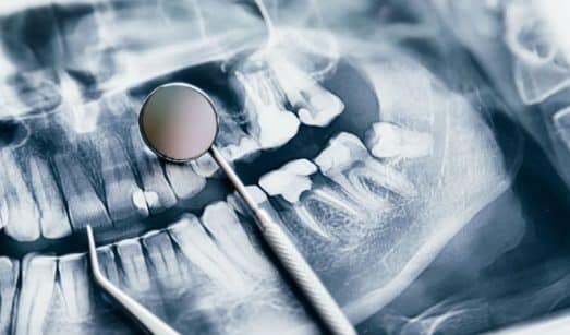 האם ניתן לשלב השתלת עצם והרמת סינוס באותו הליך תחת הרדמה מלאה