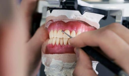 האם קיימת אפשרות להשתלת שיניים ללא השתלת עצם כלל